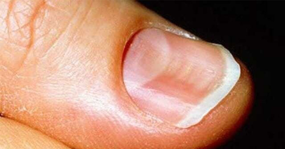 5 dấu hiệu bất thường của móng tay cảnh báo cơ thể đang có bệnh hoặc vấn đề cần thăm khám gấp