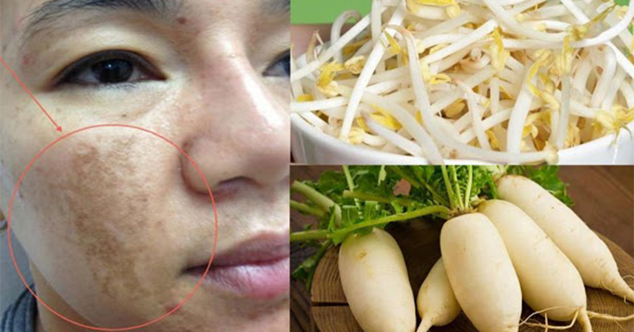 Da mặt đen sạm đầy nám cũng trở nên trắng hồng chỉ bằng nguyên liệu chưa đến 10k
