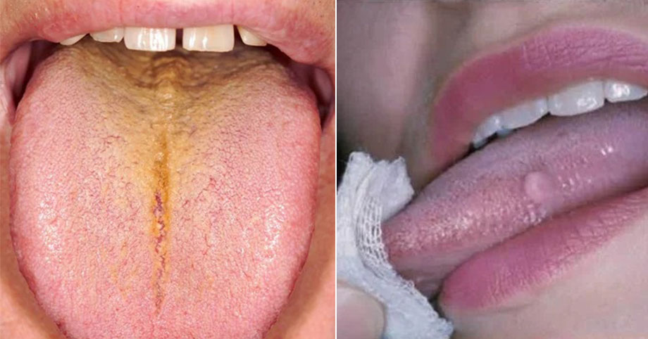 Đoán nhanh 14 chứng bệnh của cơ thể thông qua việc nhìn vào biểu hiện của lưỡi
