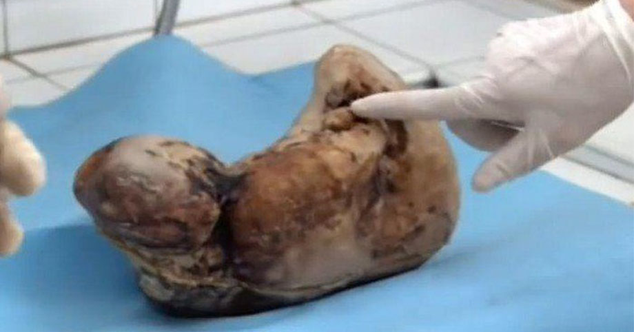 Mang bầu suốt 46 năm mới đẻ và đây chính là hình dạng đứa trẻ sau khi sinh