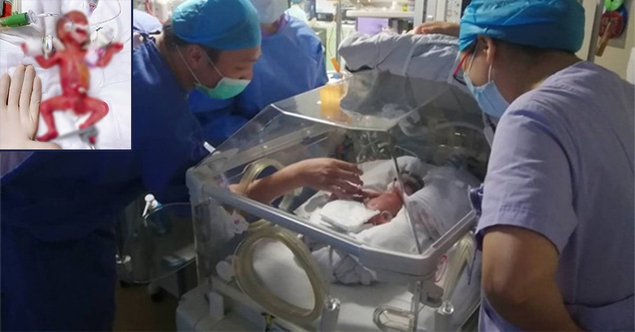 Em bé sinh non ở tuần 25 nặng vỏn vẹn chỉ 400 gram, da trong suốt, ngày ra viện cả viện cùng khóc