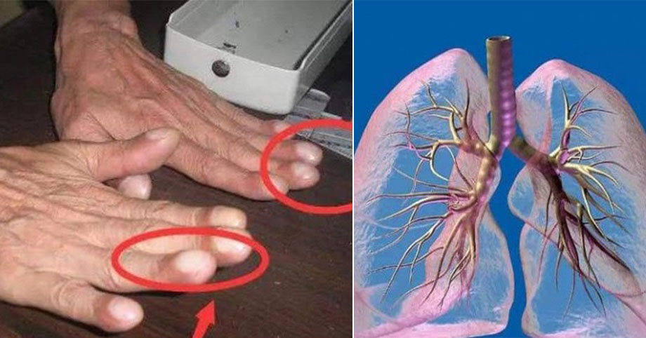 Nếu cơ thể bạn xuất hiện 4 dị thường này, phổi đang bắt đầu có bệnh, cần chú ý 𝚞𝚗𝚐 𝚝𝚑ư