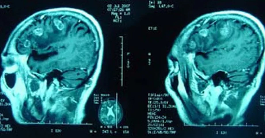 Xem kết quả chụp CT não của bé gái rơi từ tầng 12A, BS thốt lên: Không thể tưởng tượng được!