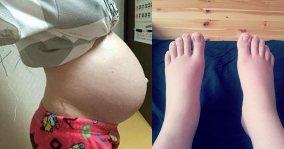 Mang thai, phụ nữ bỗng chốc biến thành  ‘𝚚𝚞á𝚒 𝚟ậ𝚝 𝚔𝚑ổ𝚗𝚐 𝚕ồ’: Chân tay sưng phù, bụng bầu lớn, đi tiểu thường xuyên