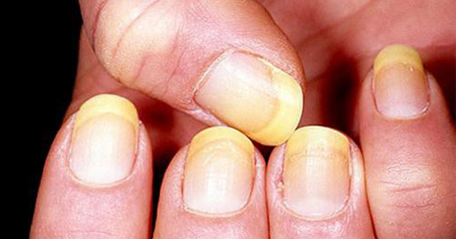 Bác sĩ mách nhìn 4 biểu hiện trên móng tay để biết mình có đang mắc bệnh tiểu đường hay không?