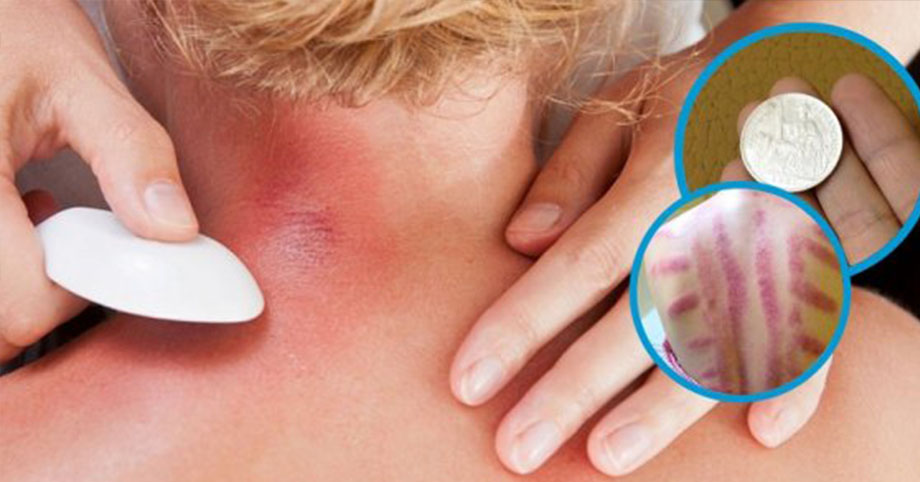 Chồng đột ngột hôn mê sâu rồi qua đời sau khi cạo gió, người vợ “khóc ngất” khi biết nguyên nhân
