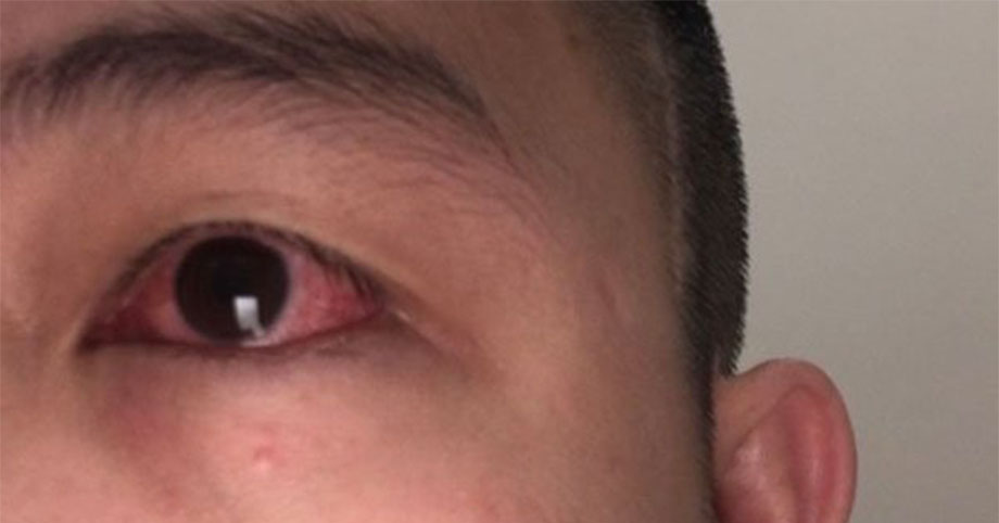 Chuyên gia cảnh báo: F0 mắc Covid-19 thấy dấu hiệu này ở mắt cần đi khám gấp, cẩn thận mù vĩnh viễn