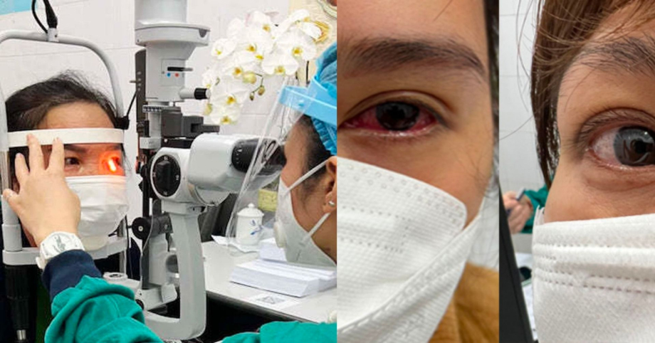 Khỏi Covid-19, mắt người phụ nữ sưng đỏ, không nhìn rõ phải vào viện điều trị gấp, bác sĩ hướng dẫn cách tránh di chứng