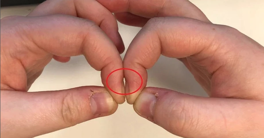 3 dấu hiệu trên ngón tay cảnh báo sức khỏe của bạn đang xuống dốc trầm trọng