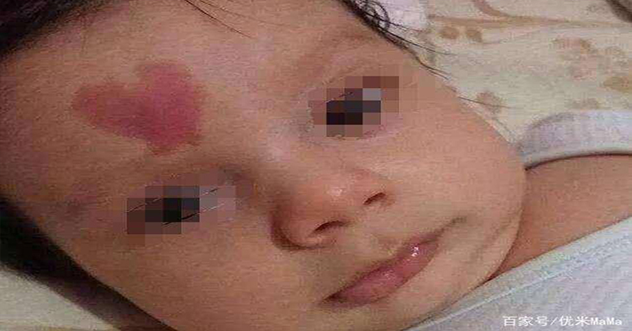 3 hành vi khi mang thai có thể gây ra vết bớt cho con, mẹ cố gắng tránh để con khỏi mặc cảm