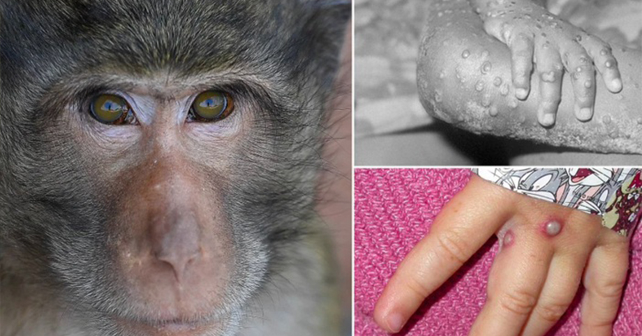 Bộ Y Tế cảnh báo hiểu hiện và 6 cách phòng tránh bệnh đậu mùa khỉ