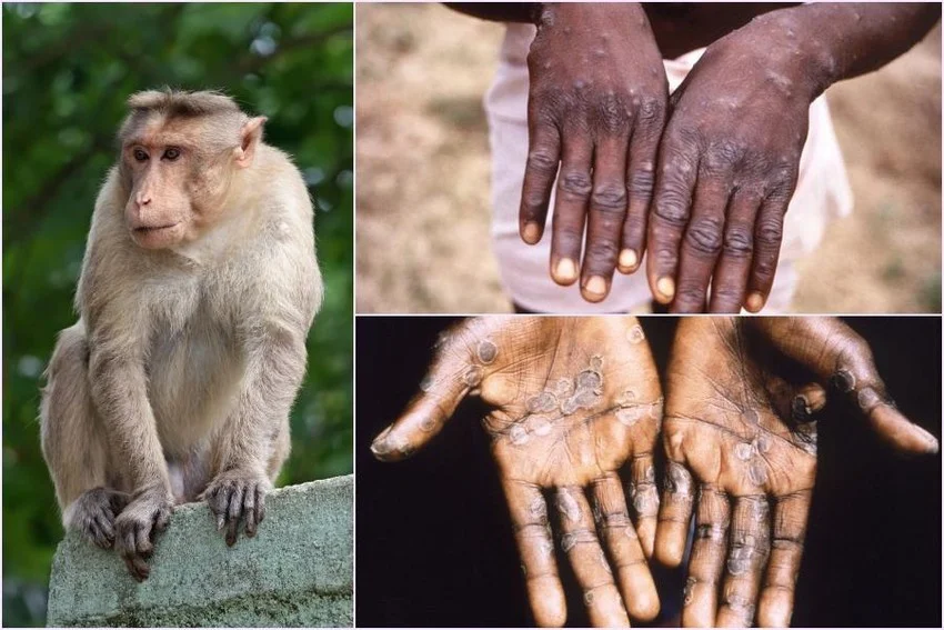 Bệnh đậu mùa khỉ: 4 đường lây truyền, 5 triệu chứng dễ nhầm lẫn