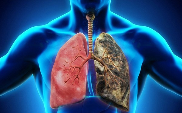 5 căn bệnh UT có nguy cơ di truyền qua nhiều đời