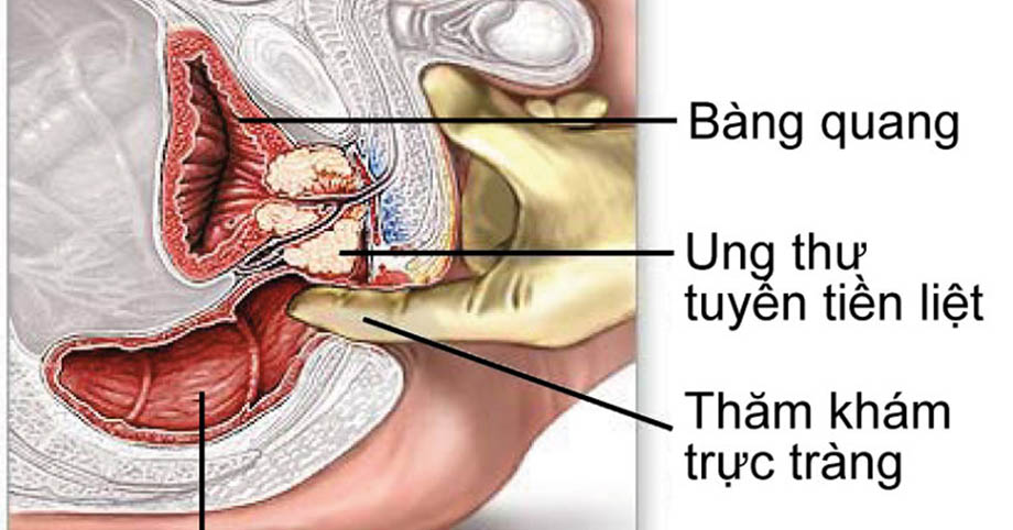 5 loại UT có tính di truyền, nếu nhà có người mắc bệnh thì con cái nên đi sàng lọc sớm