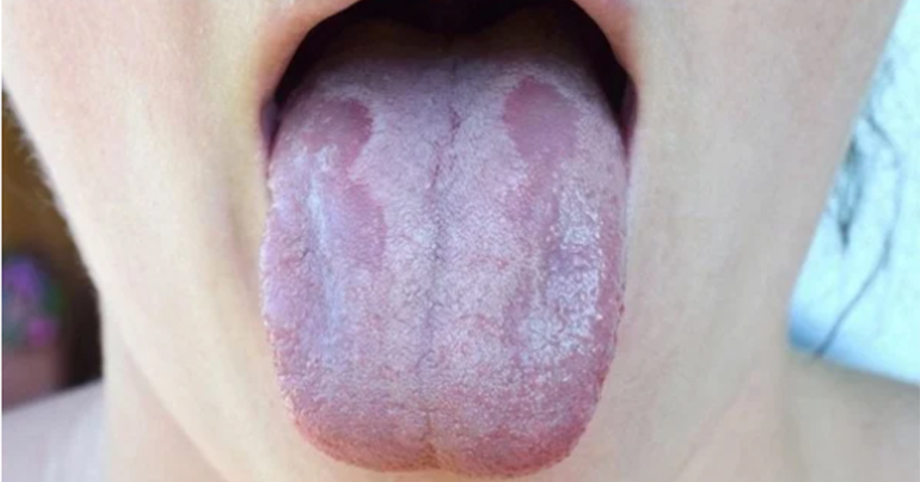 Lưỡi bỗng xuất hiện đốm trắng là dấu hiệu của bệnh gì? Trường hợp đặc biệt là thể là 𝐛ệ𝐧𝐡 𝐮𝐧𝐠 𝐭𝐡ư 𝐧𝐠𝐮𝐲 𝐡𝐢ể𝐦