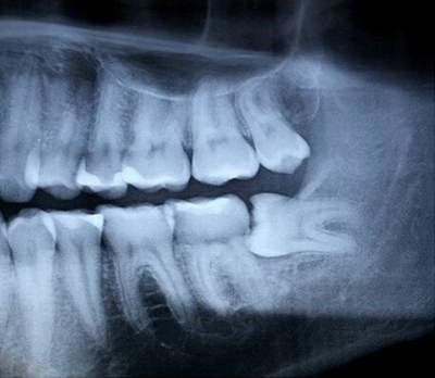 Nữ bệnh nhân không qua khỏi sau khi nhổ 4 chiếc răng khôn cùng một lúc
