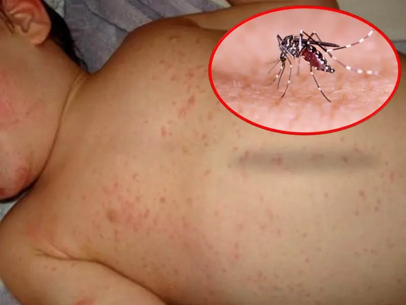 Bé trai 5 tuổi qu.a đ.ời do sốt xuất huyết, diễn biến bệnh trong 4 ngày