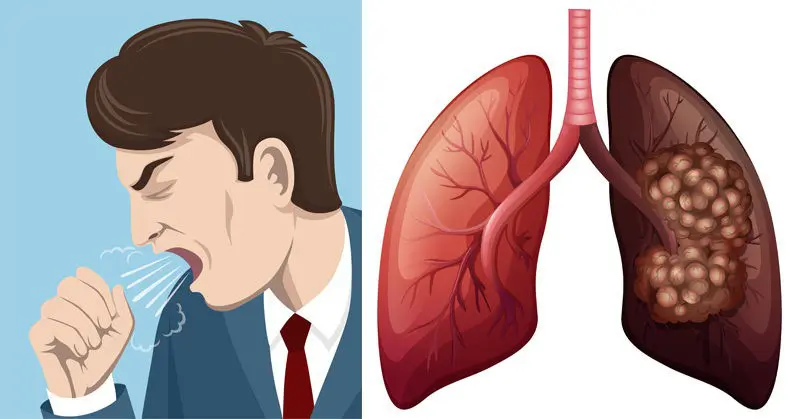 Dấu hiệu ban đầu của ‘𝘂𝗻𝗴 𝘁𝗵ư phổi’ không phải là ho khan, hai triệu chứng này bị nhiều người ‘bỏ qua’