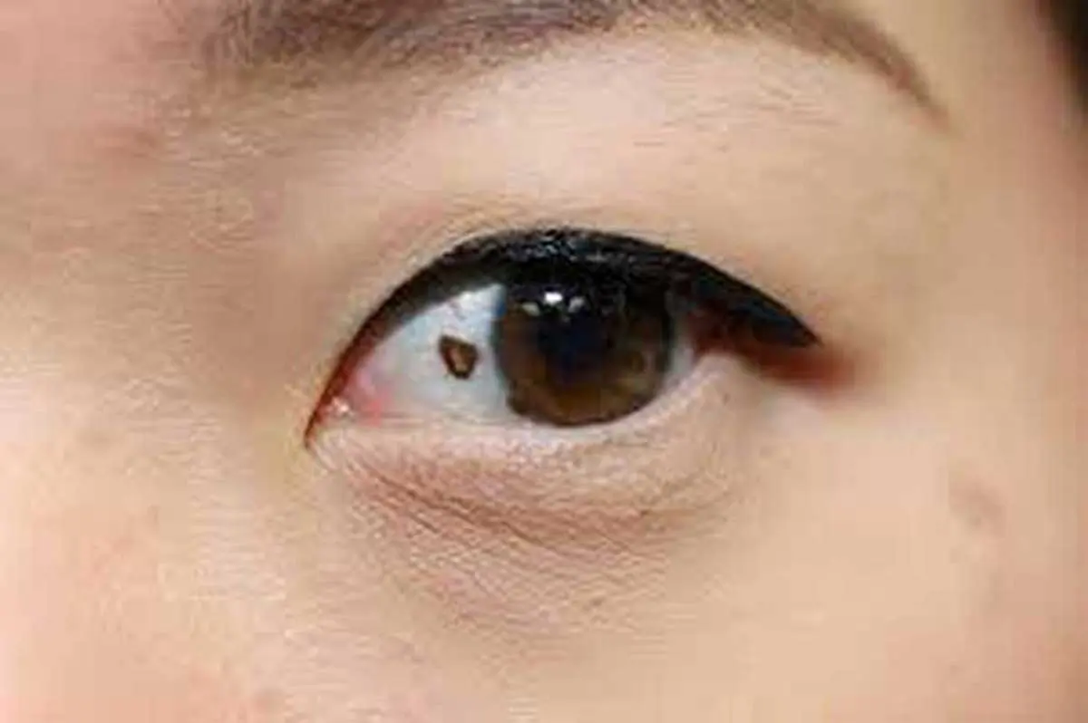 Mắt xuất hiện những triệu chứng này, 90% đang ‘ra tín hiệu’ báo động UT đang cận kề, để ý ngay nhé!
