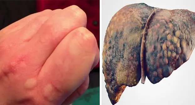 3 tín hiệu “không đau, không ngứa” ngầm cho thấy gan đang bị 𝚝ổ𝚗 𝚝𝚑ươ𝚗𝚐